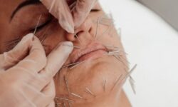Needle Shaping – autologiczne nici kolagenowe